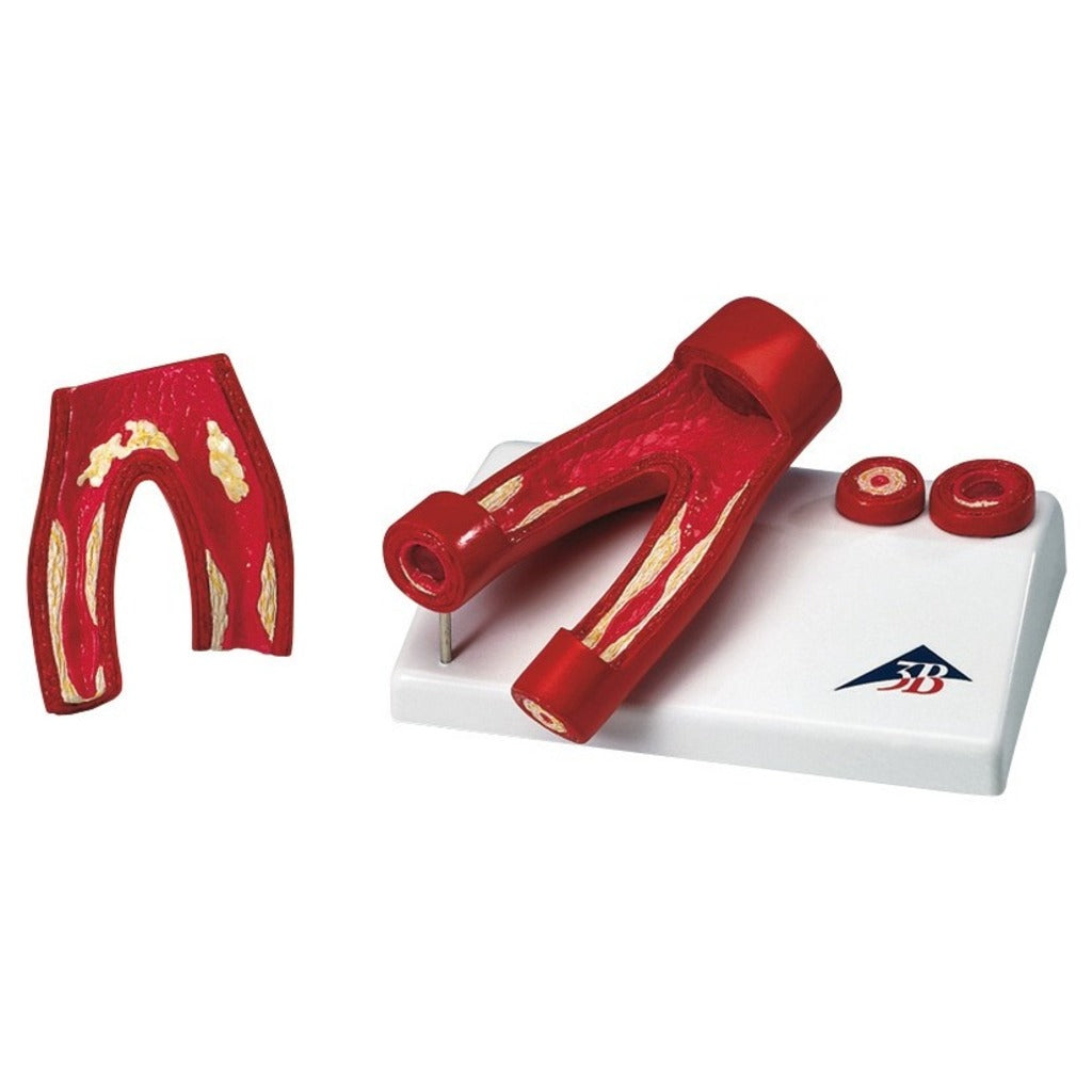 Modèle d'artériosclérose