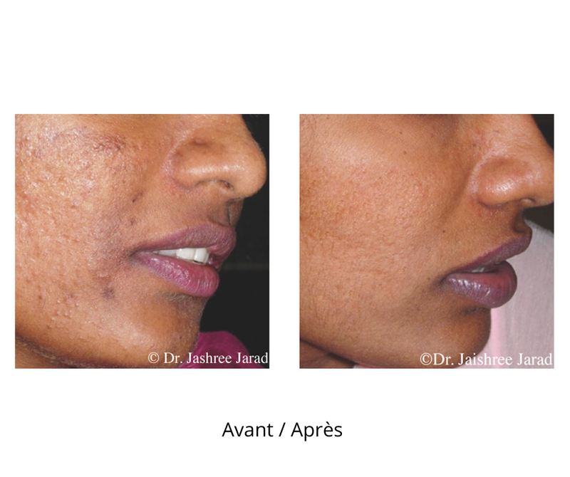 Dermaroller microneedling professionnel 9 rangées d’aiguilles avec profondeur de 1.5 mm