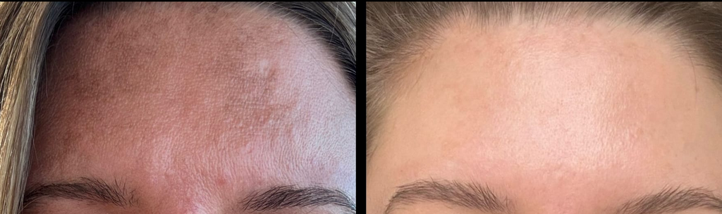 Dermaroller microneedling et son nettoyant Roller Cleaner