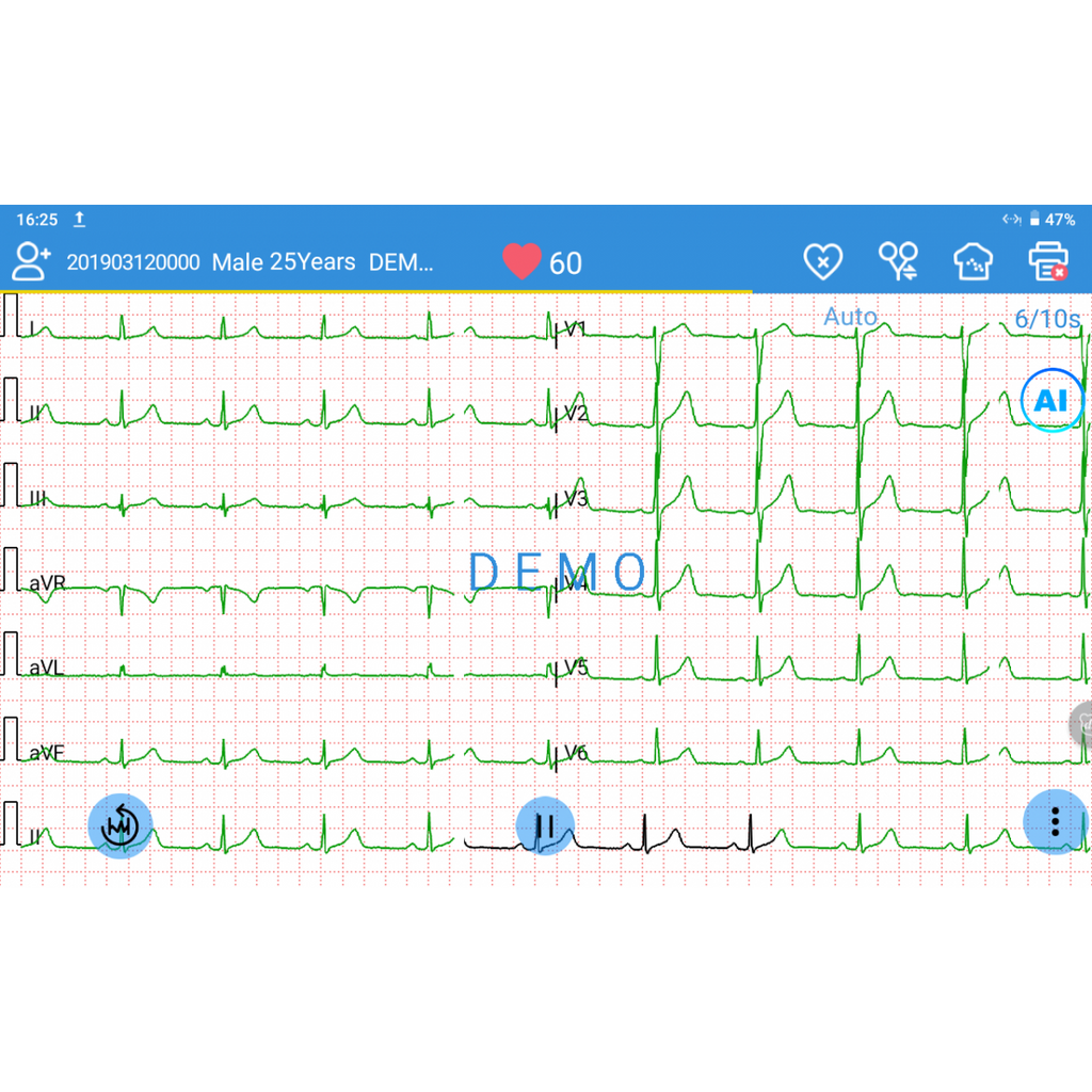ECG EDAN SE-1200 Pro 12 pistes, tactile avec imprimante