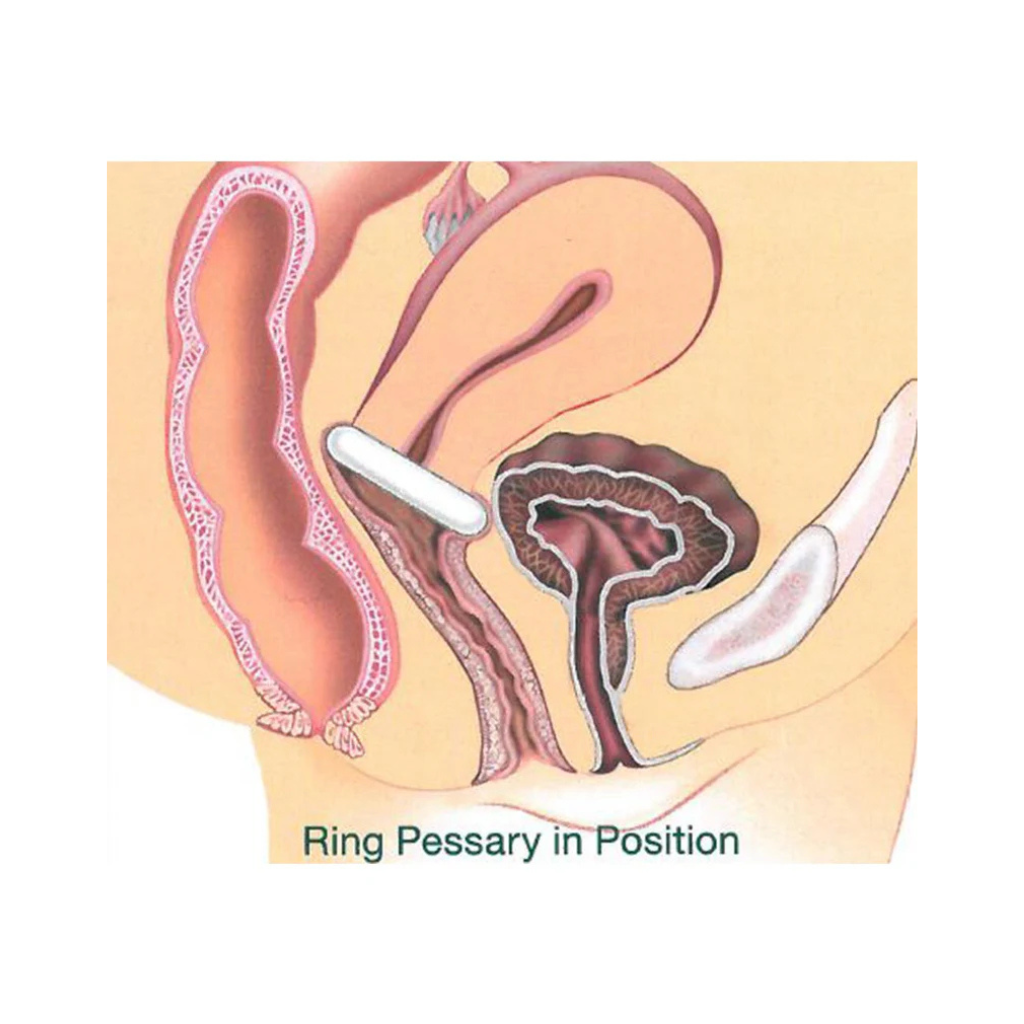 Kit Pessaire Gyn&Ring pliable petit
