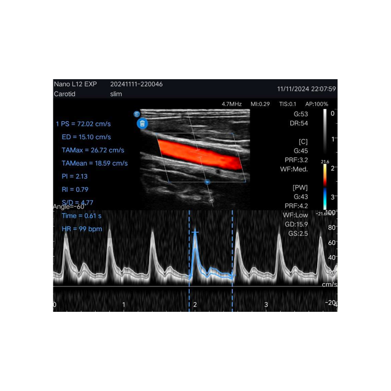 Echographe couleur portable Edan Nano linéaire