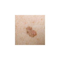 Dermatoscope LuxaScope CCT LED 2.5V Noir