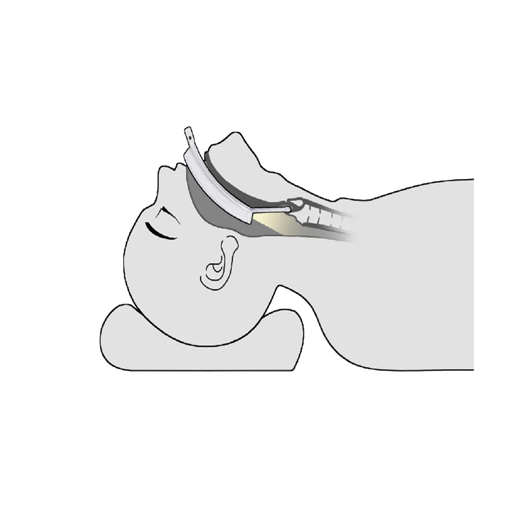 Laryngoscope vidéo LaryngoOne - One Medical