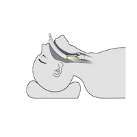 Laryngoscope vidéo LaryngoOne - One Medical