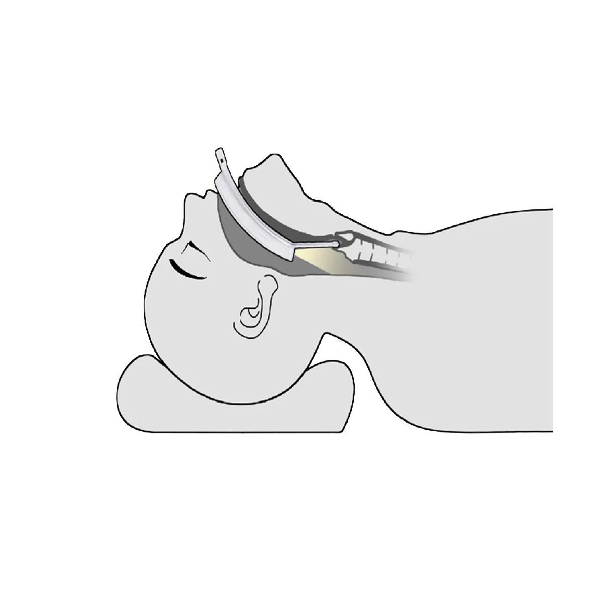 Laryngoscope vidéo LaryngoOne - One Medical