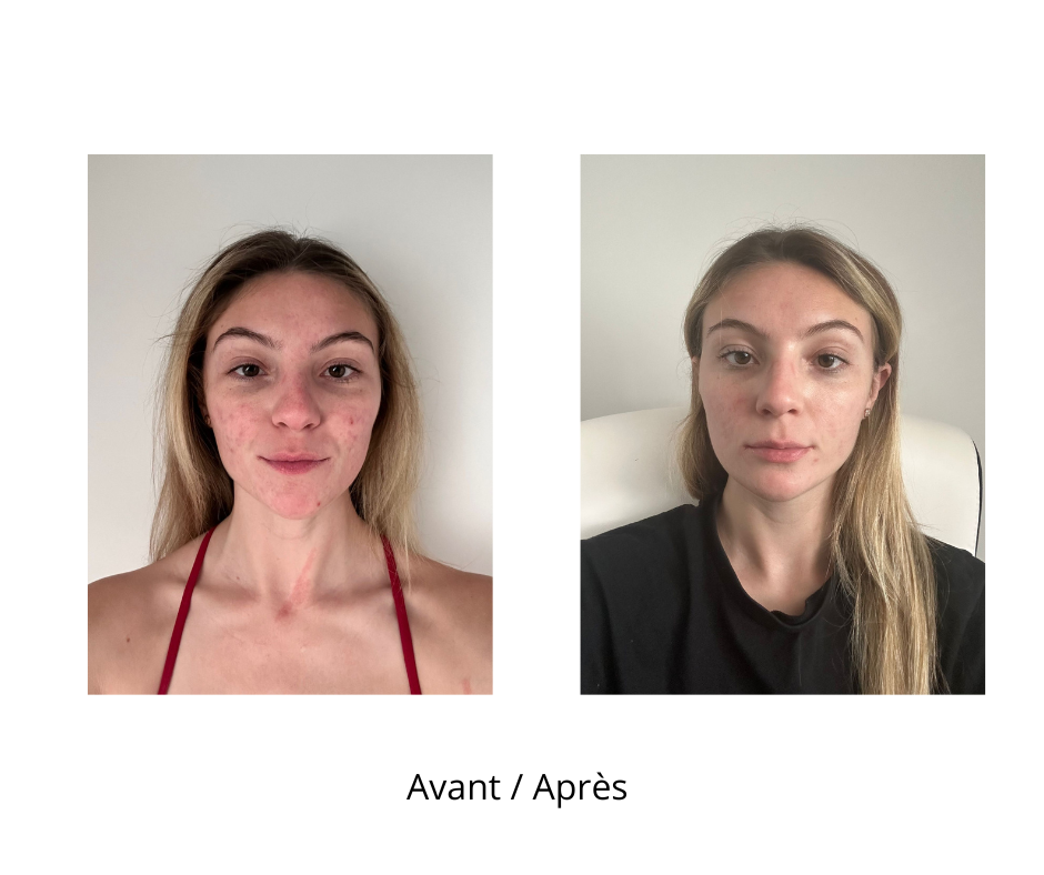 Dermaroller microneedling et son nettoyant Roller Cleaner