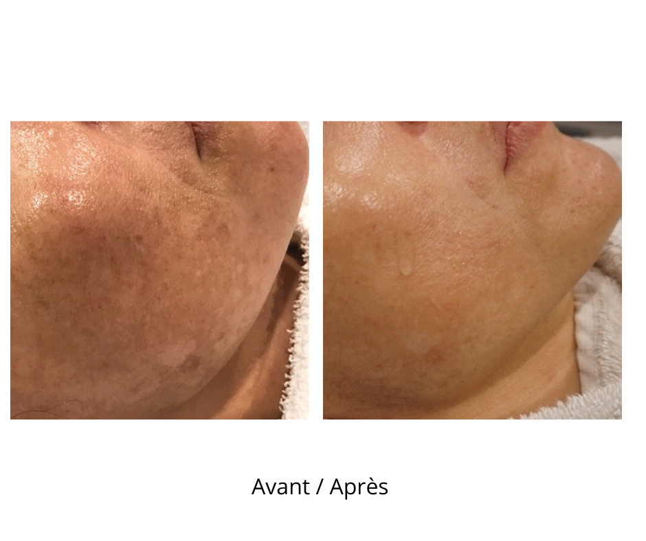 Dermaroller microneedling professionnel 9 rangées d’aiguilles avec profondeur de 1.5 mm