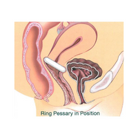 Kit Pessaire Ring Dr Arabin Petit